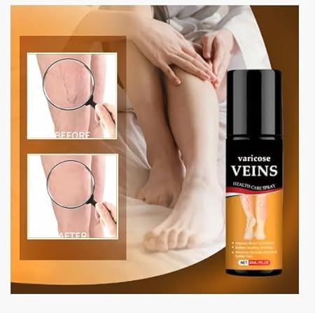 Varicose Veins Spray ( Pack of 2)